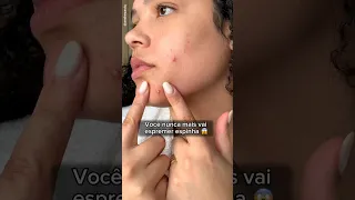 Você espreme suas espinhas?😱Não faça mais isso!