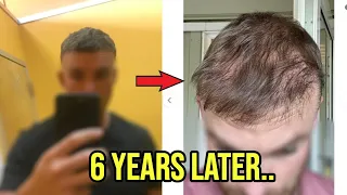 HAIR TRANSPLANT WITHOUT FINASTERIDE FOR 6 YEARS!! THIS IS WHAT HAPPENED...
