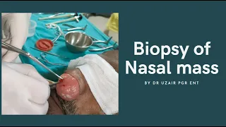 Biopsy of nasal tumor