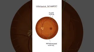 Hypertensive Retinopathy #medicine #medicalstudent #ophthalmology #optometrystudent