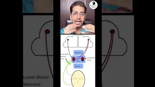 Bell’s palsy! (Where is the lesion?) UMN or LMN? #bellspalsy #neurology #shorts