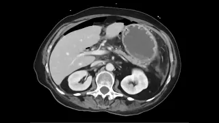 Bowel perforation identification CT