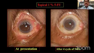 AIOC2021-FP716-Dr. MAURYA R P- Extensive Ocular Surface Squamous Neoplasia