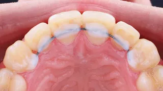 Simple way to place retainer/легкий метод установки ретейнера