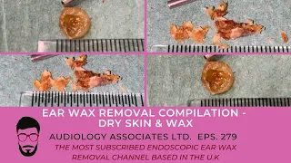 EAR WAX REMOVAL COMPILATION - DRY SKIN & WAX - EP 279