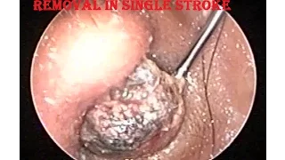 Hard Impacted Huge Ear Wax removal in single stroke