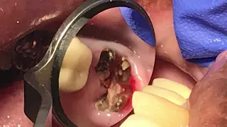 How to extract broken endodontic treated molar by Dr. Loc Q. Huynh, DMD