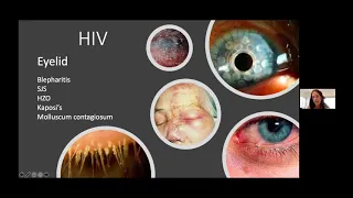 Ocular Manifestations of Infectious Diseases - Nira Esra