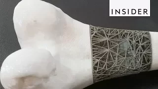 3D Printed Implants Could Help Patients with Bone Cancer