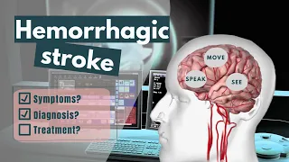 Hemorrhagic stroke | Symptoms, diagnosis, treatment, complications & risk factors