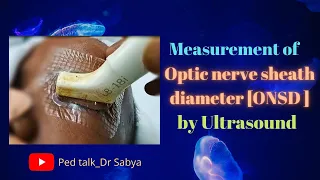 Optic nerve sheath diameter/ measurement of ONSD/ ONSD for papilloedema & raised ICP/ POCUS/#DrSabya