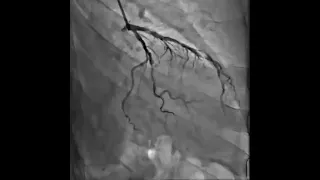 massive coronary perforation.oversized balloon post dilatation. managed by universal algorithm.