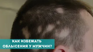 Как избежать облысения у мужчин?