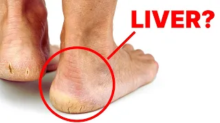 Is Your Liver Crying for Help? Check Your Feet for These Alarming Signs!