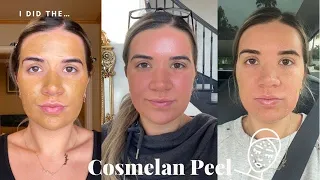 The Cosmelan Peel II My 1st Chemical Peel in Over TWO Years!