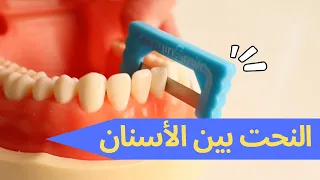 ما فائدة النحت بين الأسنان 🫤