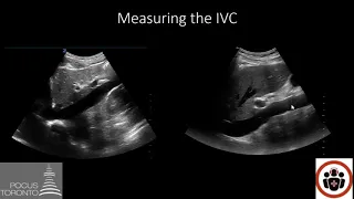 POCUS Cases 4: IVC POCUS for volume status