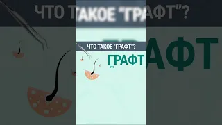 Пересадка волос - что такое «графт» ?🤔👨🏻‍⚕️