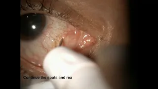 Treatment of Conjunctival Cyst Ablation using ALTP - Supplementary video [ID 265032]