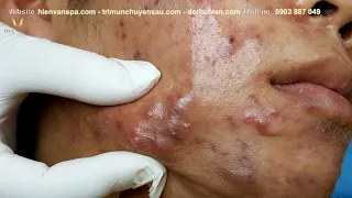 Poor Younger with many "Cysts" at hien van spa|347|Trọng Hải