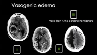 Imaging of Brain tumors Dr Mamdouh Mahfouz