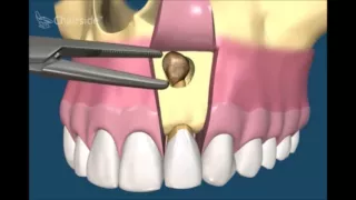 Хирургическая стоматология  Удаление кисты зуба и резекция корня зуба.