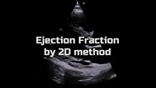 Ejection Fraction by 2D method