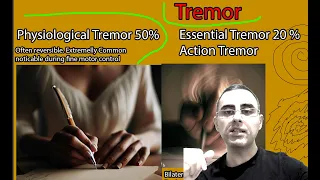 Tremor Causes:   Shaking hands (hand tremors): Physiological Tremor or Parkinson?