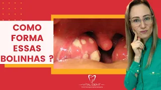 Como que forma essas bolinhas da garganta? #caseoamigdaliano #garganta #amigdala #dentista