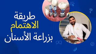 طريقة الاهتمام بزراعة الاسنان