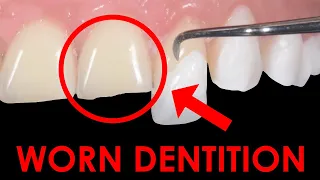 How To Diagnose & Treat Patients with Worn Dentition | The Index Technique & Indirect Restorations.