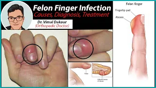 FINGER INFECTION - felon finger infection  causes , diagnosis,  treatment  in hindi   |