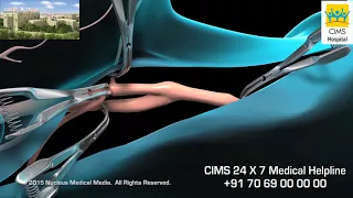 Carotid Endarterectomy - CIMS Hospital