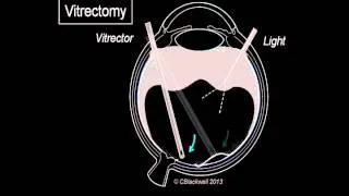 Vitreous 3: Vitrectomy Surgery