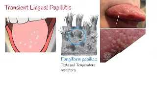 Transient lingual papillitis (Lie Bumps) - Inflammation of the tongue