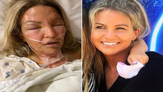 Texas Mom Severely Burned When Hand Sanitizer Bottle Explodes