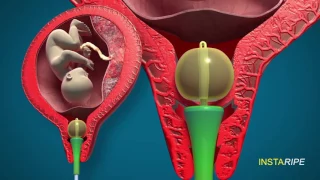 Dr. Panicker's Rapid Cervical Ripening Device - INSTARIPE