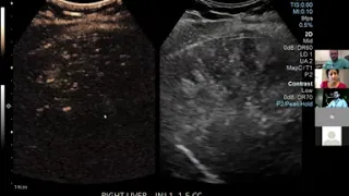 Fetzer wows us again with Ultrasound bubble case!  - Dr. David Fetzer