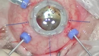 Temporary Landers keratoprosthesis in two specific cases - İki Landers geçici keratoprotez vakası