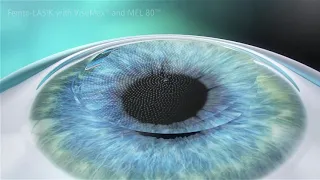 LASIK Procedure Animation