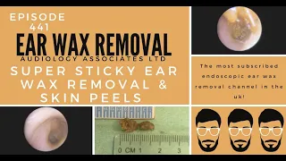 SUPER STICKY EAR WAX REMOVAL & SKIN PEELS - EP441