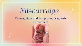 MISCARRIAGE, Causes, Signs and Symptoms, Diagnosis and Treatment.