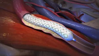 Peripheral Vascular Disease balloon stent by Gore Medical