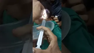 Foreign Body Removal from Ear