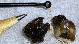 45 - Huge Ear Wax Plugs Extracted with Jobson Horne using the WAXscope®️