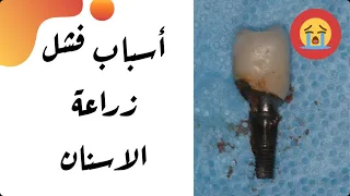 أسباب فشل زراعة الاسنان