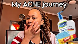 HOW I CLEARED MY SKIN IN ALMOST A YEAR!! | Namibian YouTubers