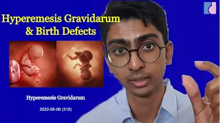 Hyperemesis Gravidarum & Birth Defects - Antai Hospitals