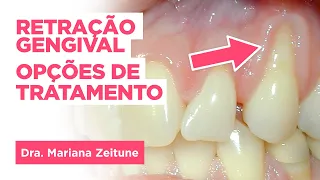 Retração ou Afastamento Gengival: Opções de Tratamento | Dra. Mariana Zeitune