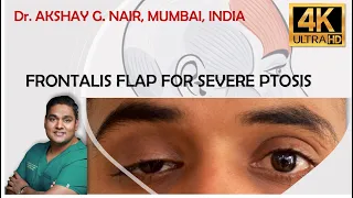 Frontalis Flap for Severe Ptosis (4K) - Dr. Akshay Nair, Mumbai, India